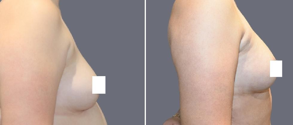 Breast Fat Transfer Pre2024 008 Before And After