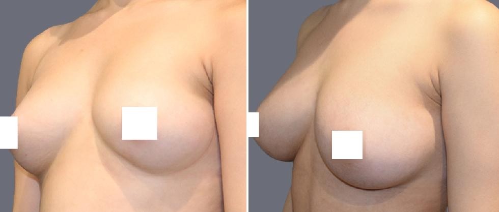 Breast Fat Transfer Pre2024 009 Before And After