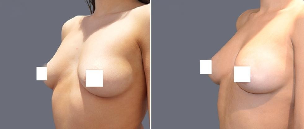 Breast Fat Transfer Pre2024 010 Before And After