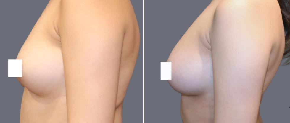 Breast Fat Transfer Pre2024 011 Before And After