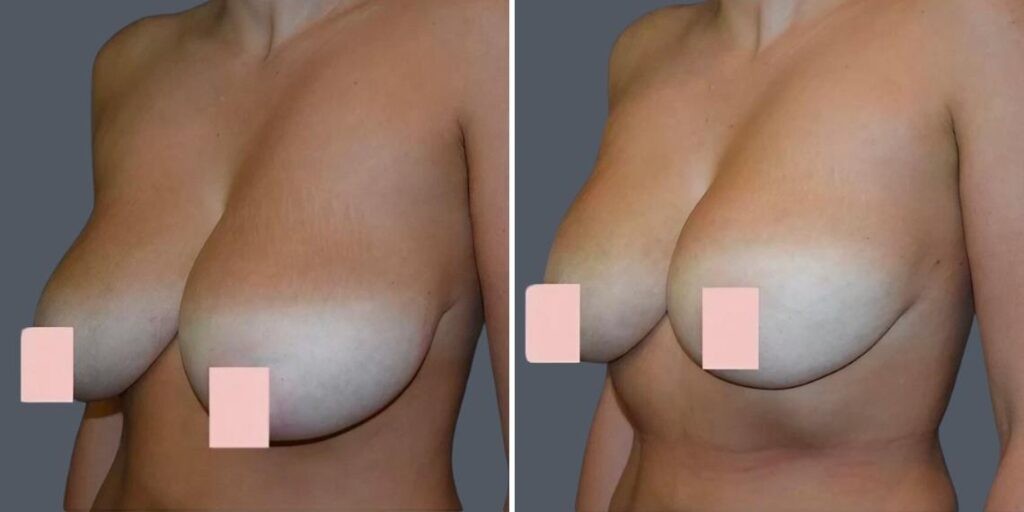 Breast Liposuction Female Pre2024 001 Before And After