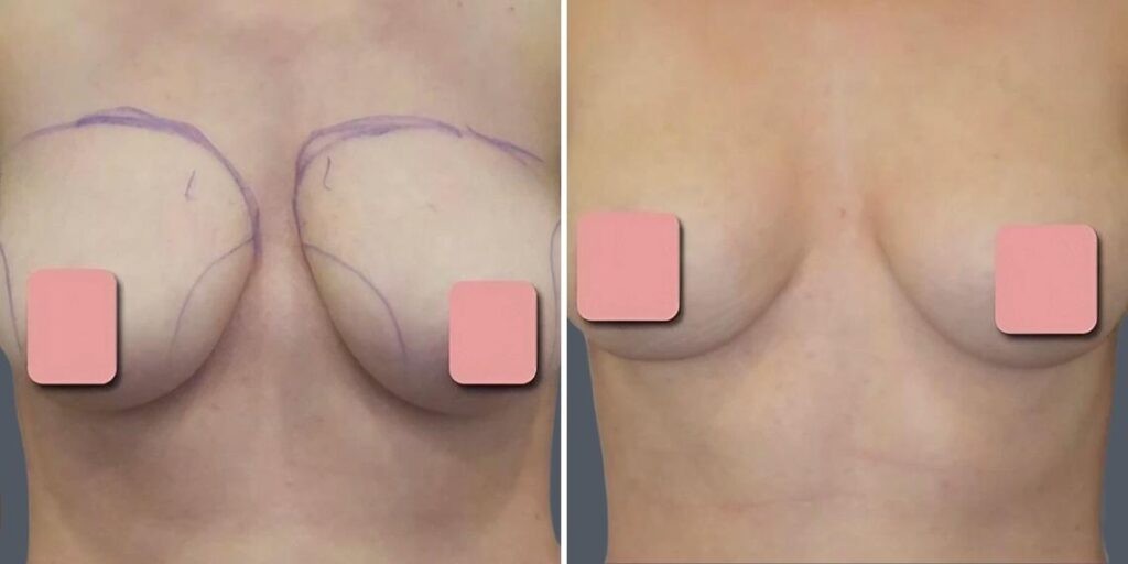 Breast Liposuction Female Pre2024 002 Before And After