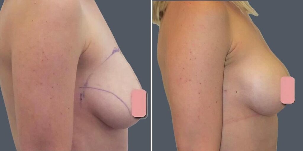 Breast Liposuction Female Pre2024 003 Before And After