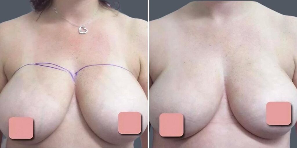 Breast Liposuction Female Pre2024 004 Before And After