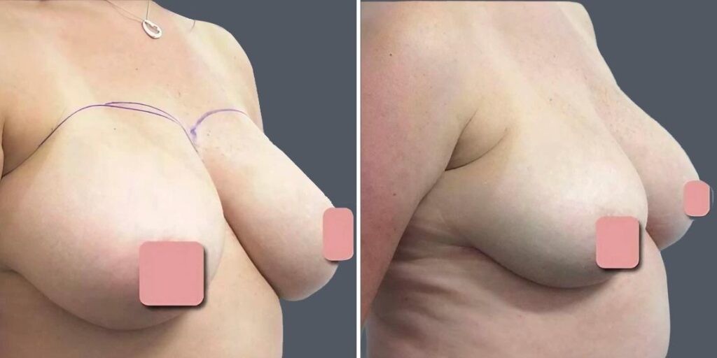 Breast Liposuction Female Pre2024 005 Before And After