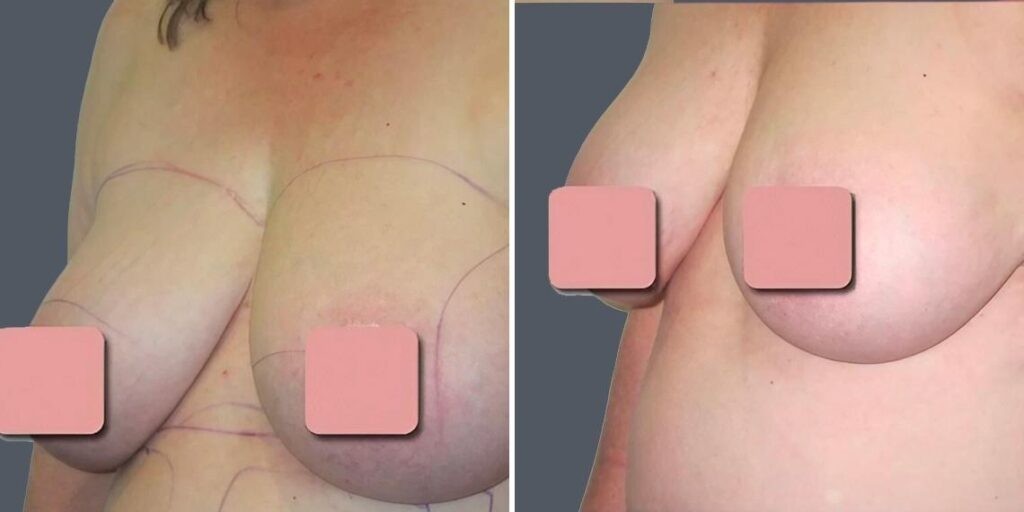 Breast Liposuction Female Pre2024 006 Before And After