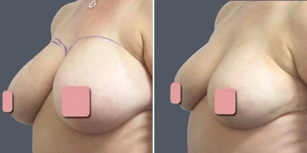 Breast Liposuction Female Pre2024 007 Before And After