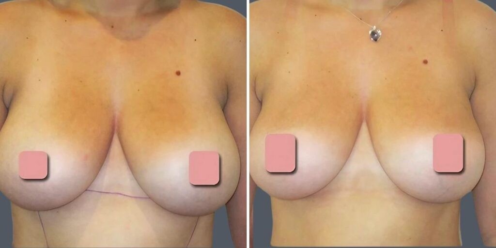 Breast Liposuction Female Pre2024 008 Before And After