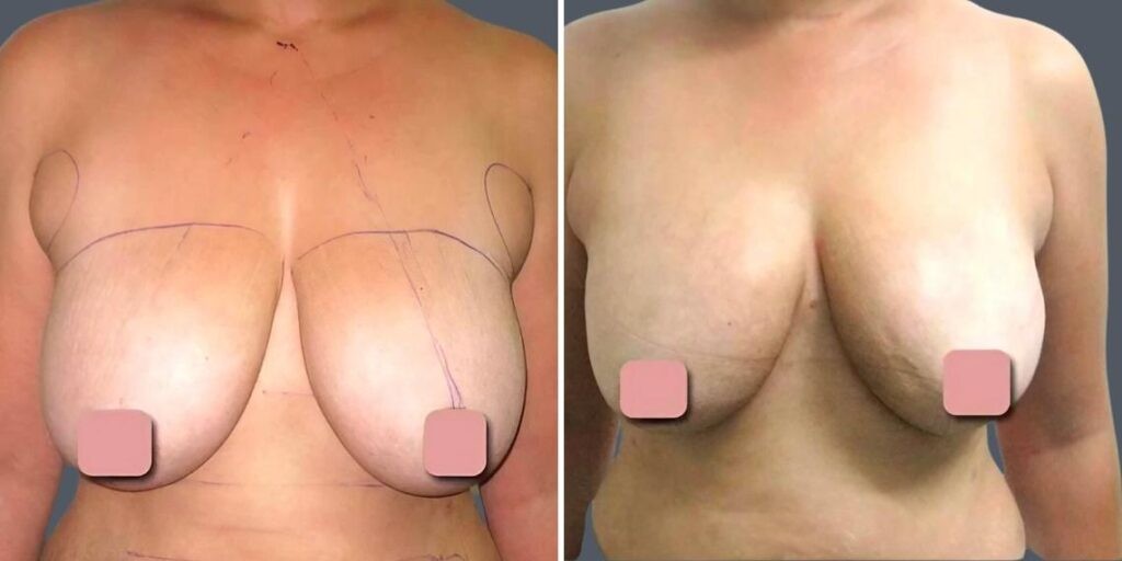 Breast Liposuction Female Pre2024 009 Before And After