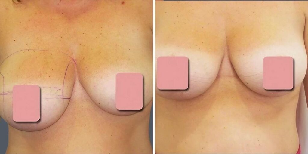 Breast Liposuction Female Pre2024 010 Before And After