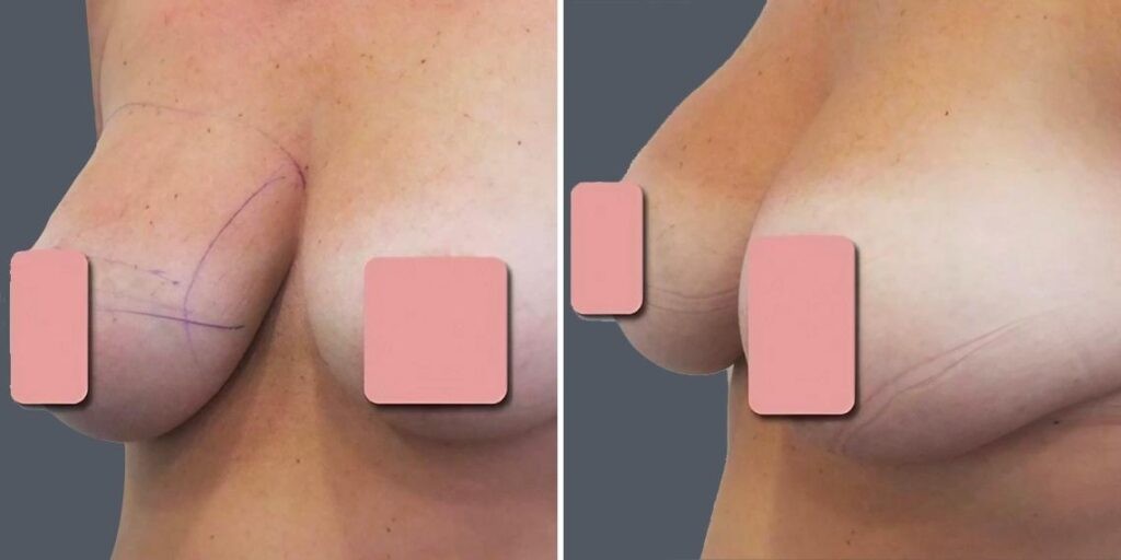 Breast Liposuction Female Pre2024 011 Before And After