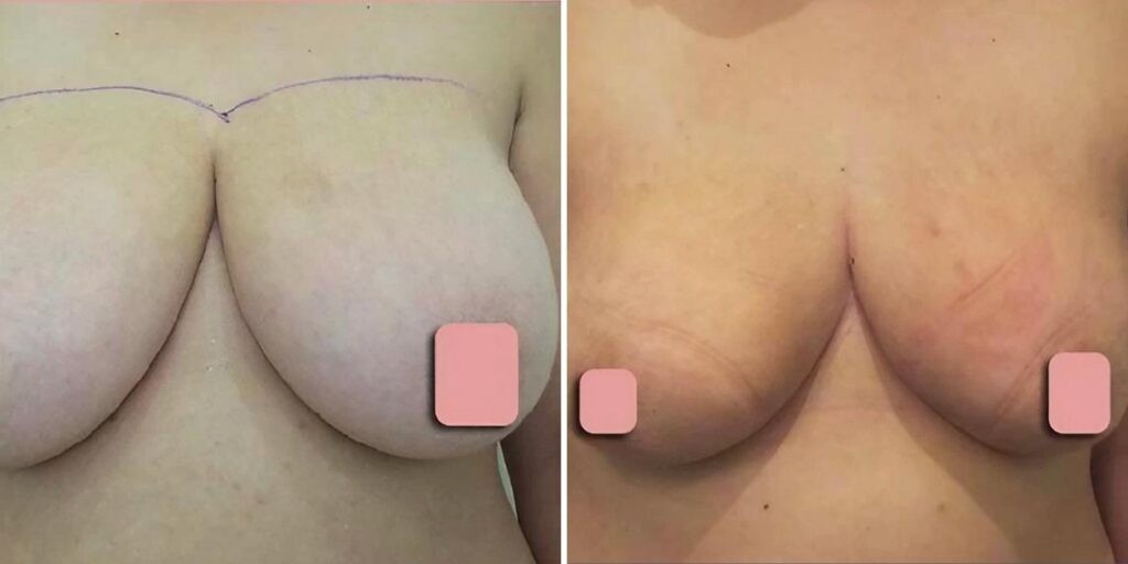 Breast Liposuction Female Pre2024 012 Before And After