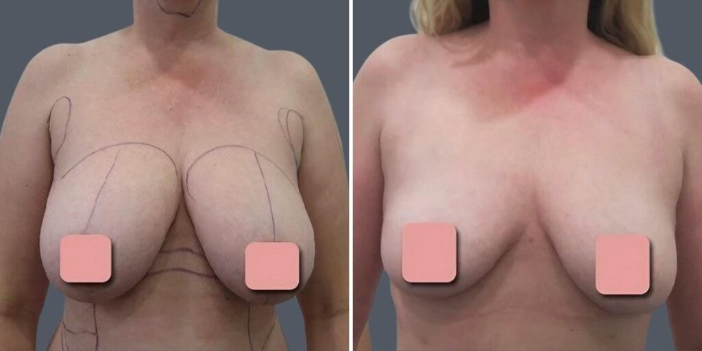 Breast Liposuction Female Pre2024 013 Before And After