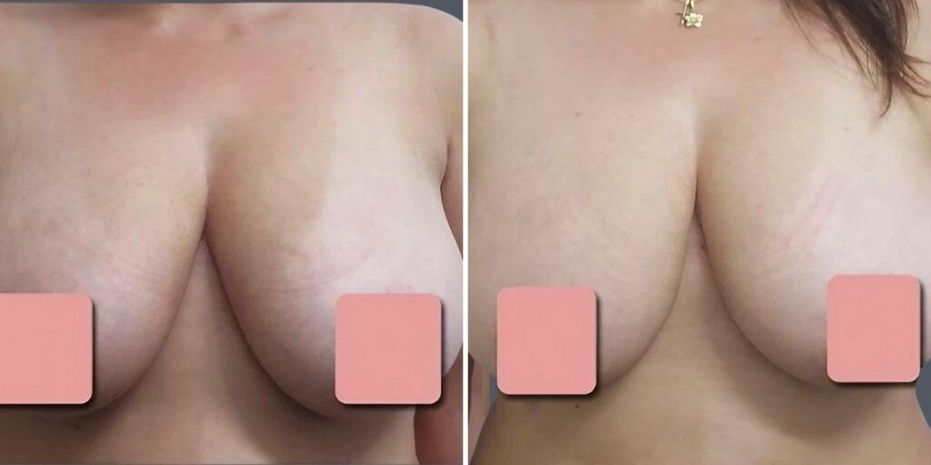 Breast Liposuction Female Pre2024 014 Before And After