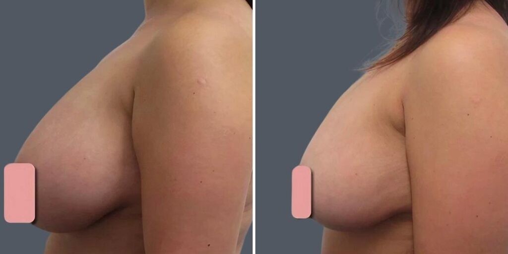 Breast Liposuction Female Pre2024 015 Before And After