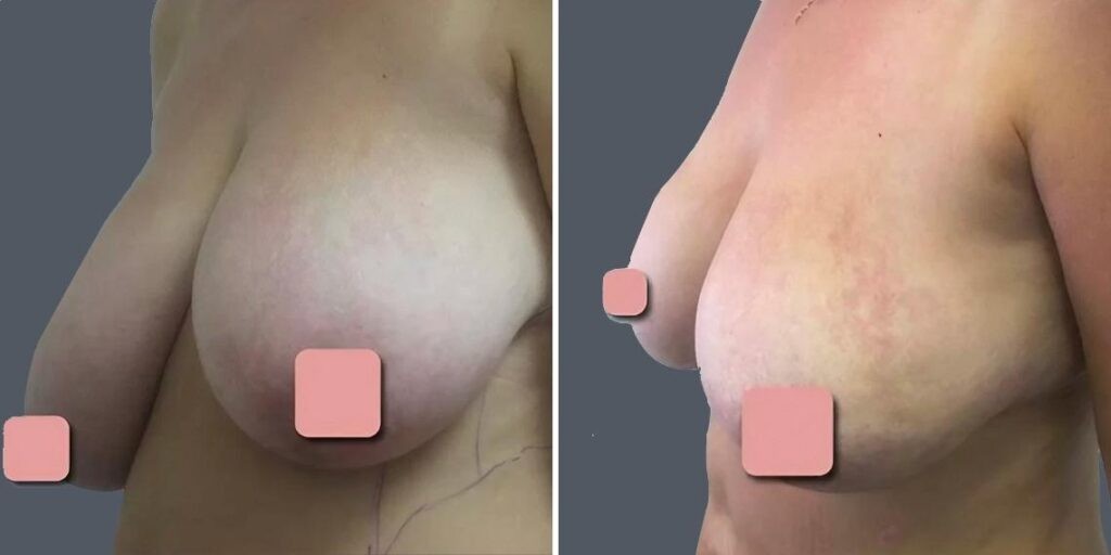 Breast Liposuction Female Pre2024 016 Before And After