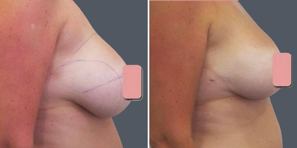 Breast Liposuction Female Pre2024 017 Before And After