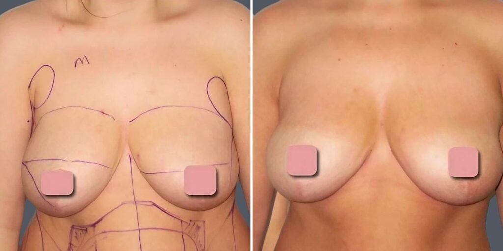 Breast Liposuction Female Pre2024 018 Before And After
