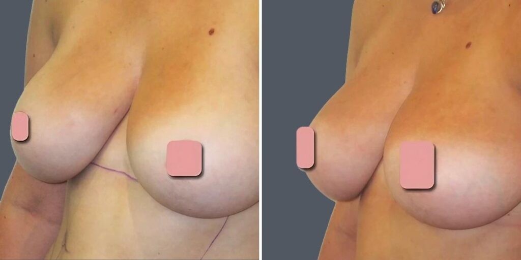 Breast Liposuction Female Pre2024 019 Before And After