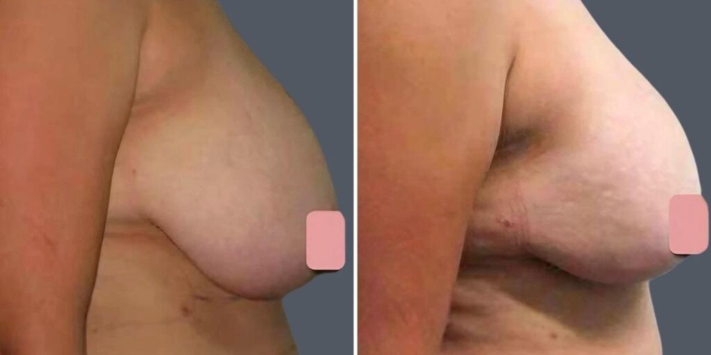 Breast Liposuction Female Pre2024 020 Before And After
