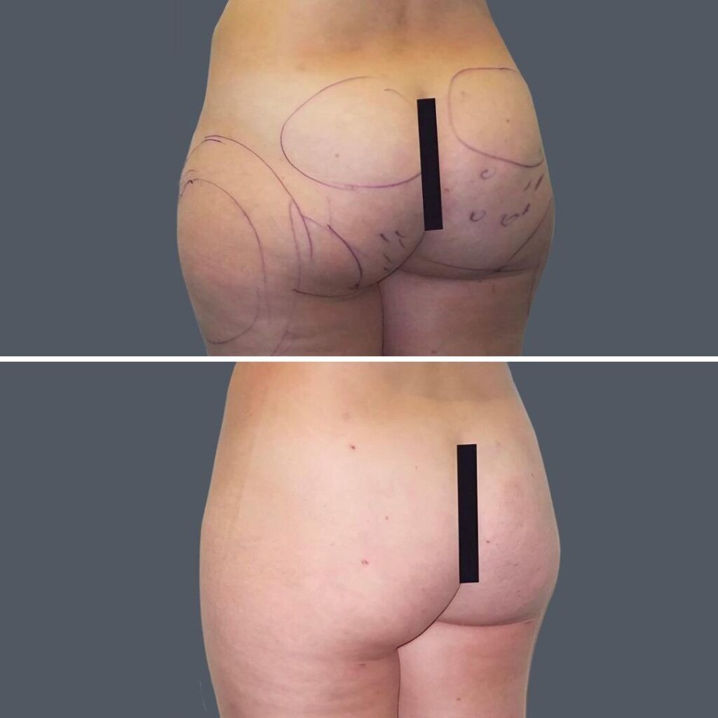 Buttock Reduction Female Pre2024 001 Before And After