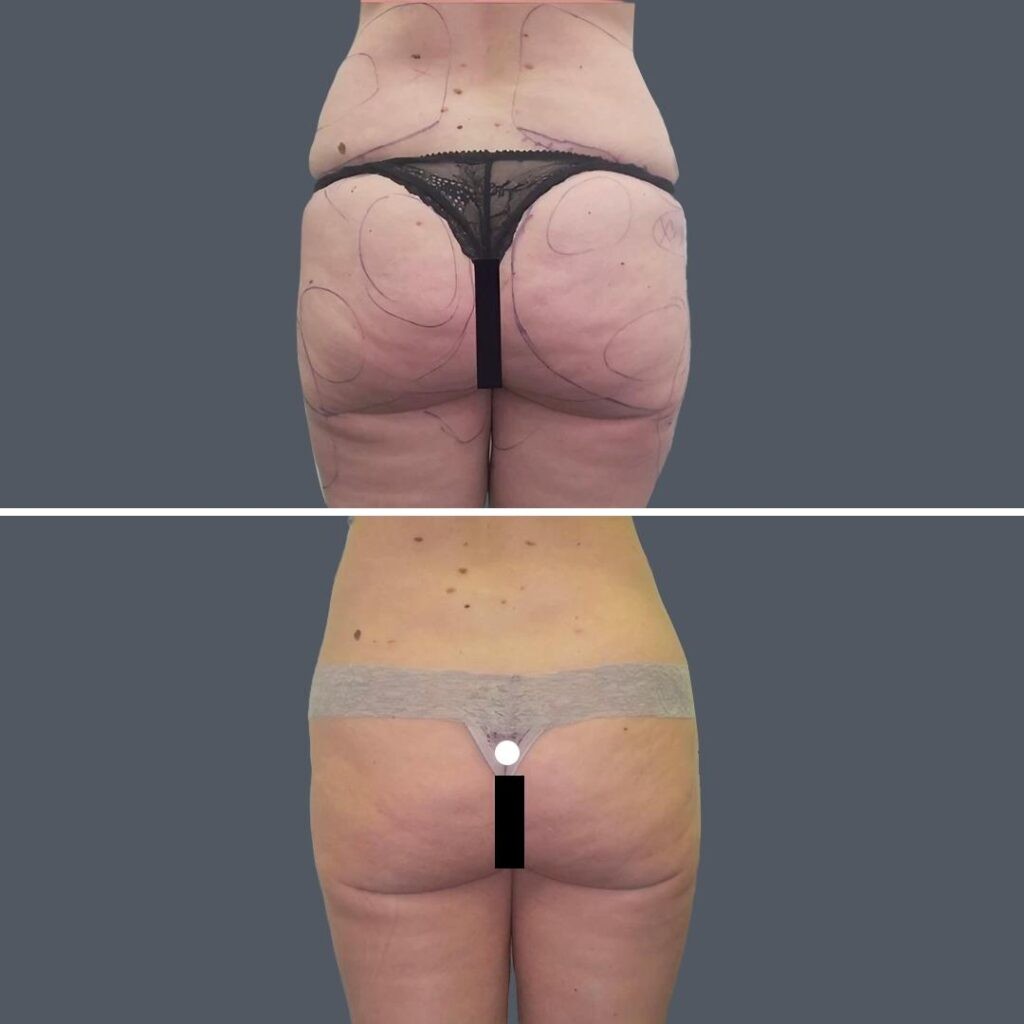 Buttock Reduction Female Pre2024 002 Before And After