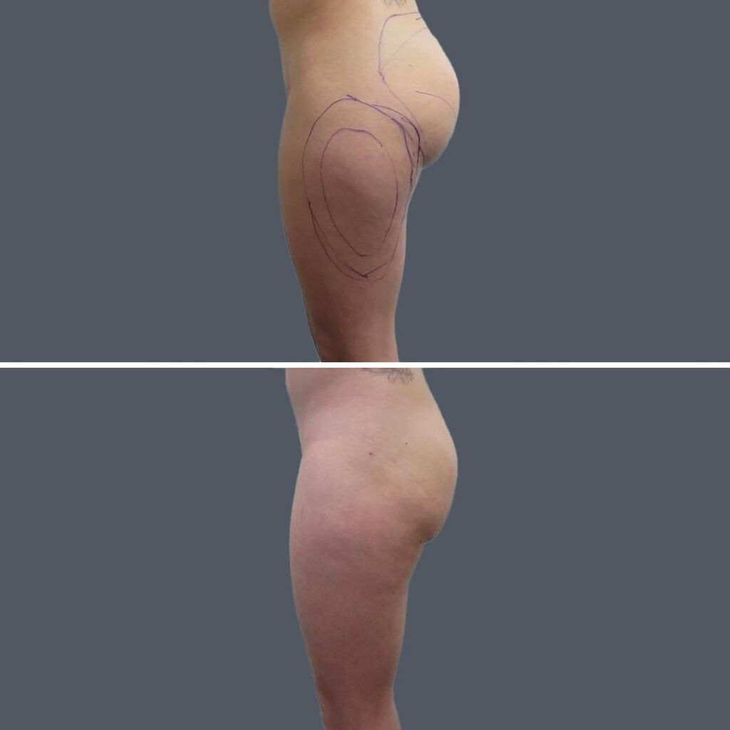 Buttock Reduction Female Pre2024 003 Before And After