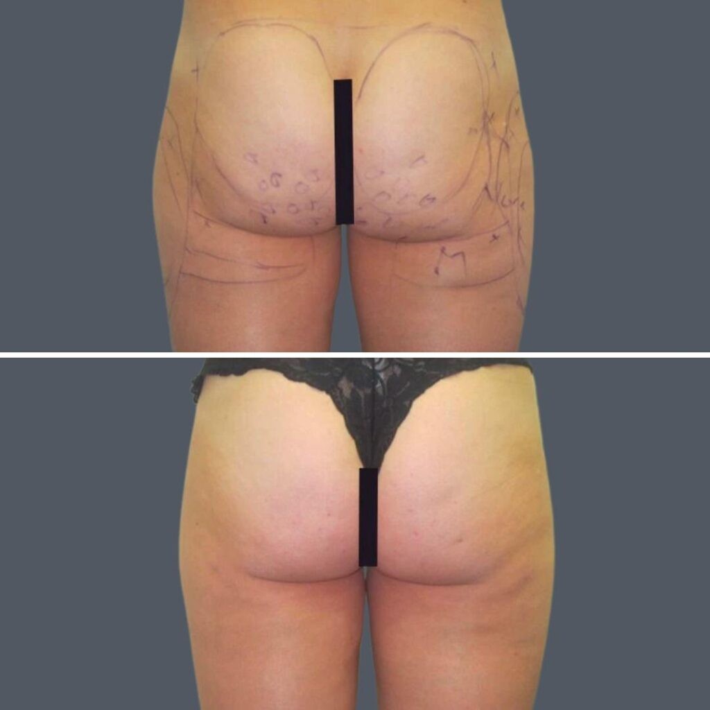 Buttock Reduction Female Pre2024 004 Before And After