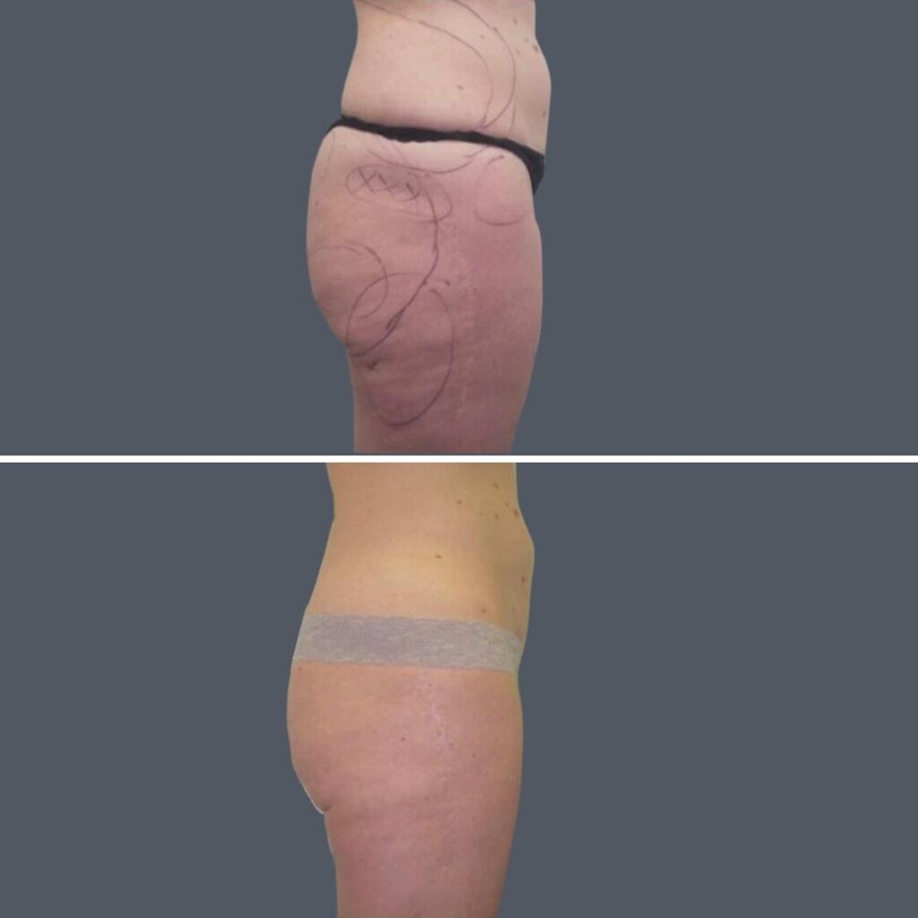 Buttock Reduction Female Pre2024 005 Before And After