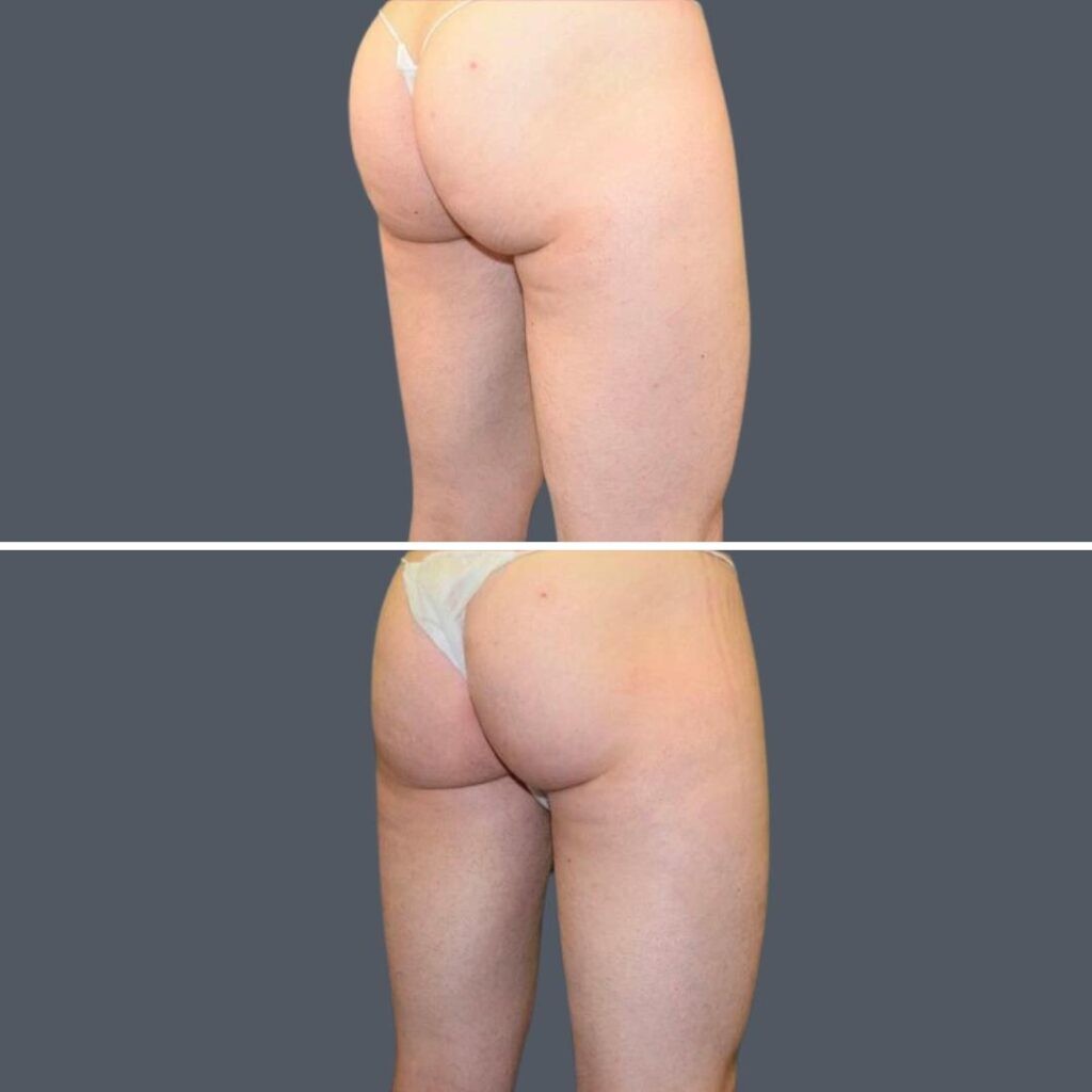 Buttock Reduction Female Pre2024 006 Before And After