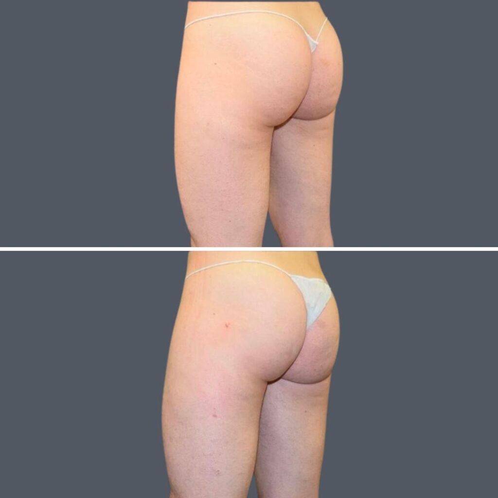 Buttock Reduction Female Pre2024 007 Before And After