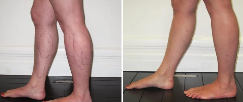 Calf Ankle Liposuction Female Pre2024 008 Before And After