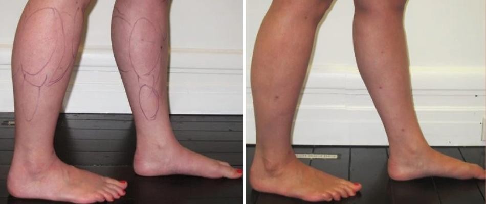 Calf Ankle Liposuction Female Pre2024 009 Before And After