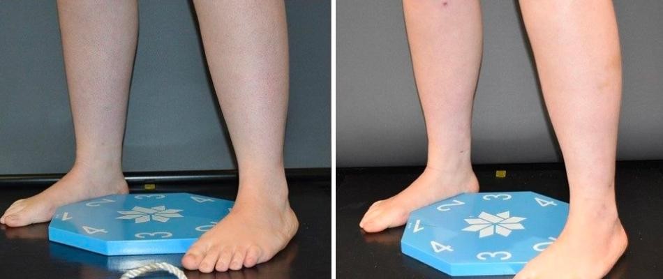 Calf Ankles Coolsculpting Liposuction Female Pre2024 011 Before And After