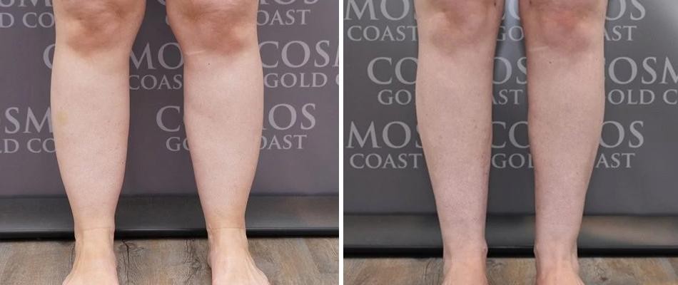 Calf Liposuction Female Pre2024 005 Before And After