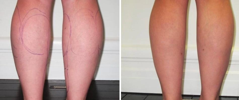 Calf Liposuction Female Pre2024 010 Before And After