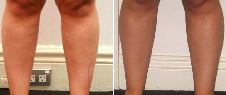 Calf Liposuction Female Pre2024 012 Before And After