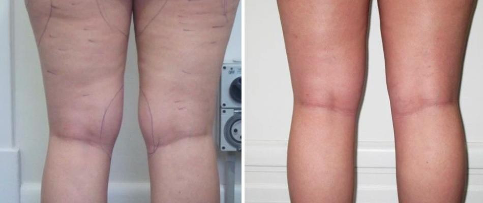 Calf Thighs Liposuction Female Pre2024 013 Before And After