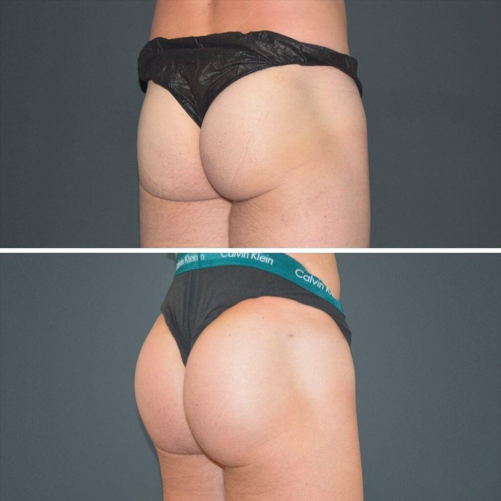 Canberra Bbl Butt Male 2022 Left De Before And After