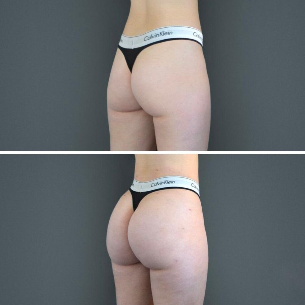 Canberra Bbl Female Butt 2022 Left Sa Before And After