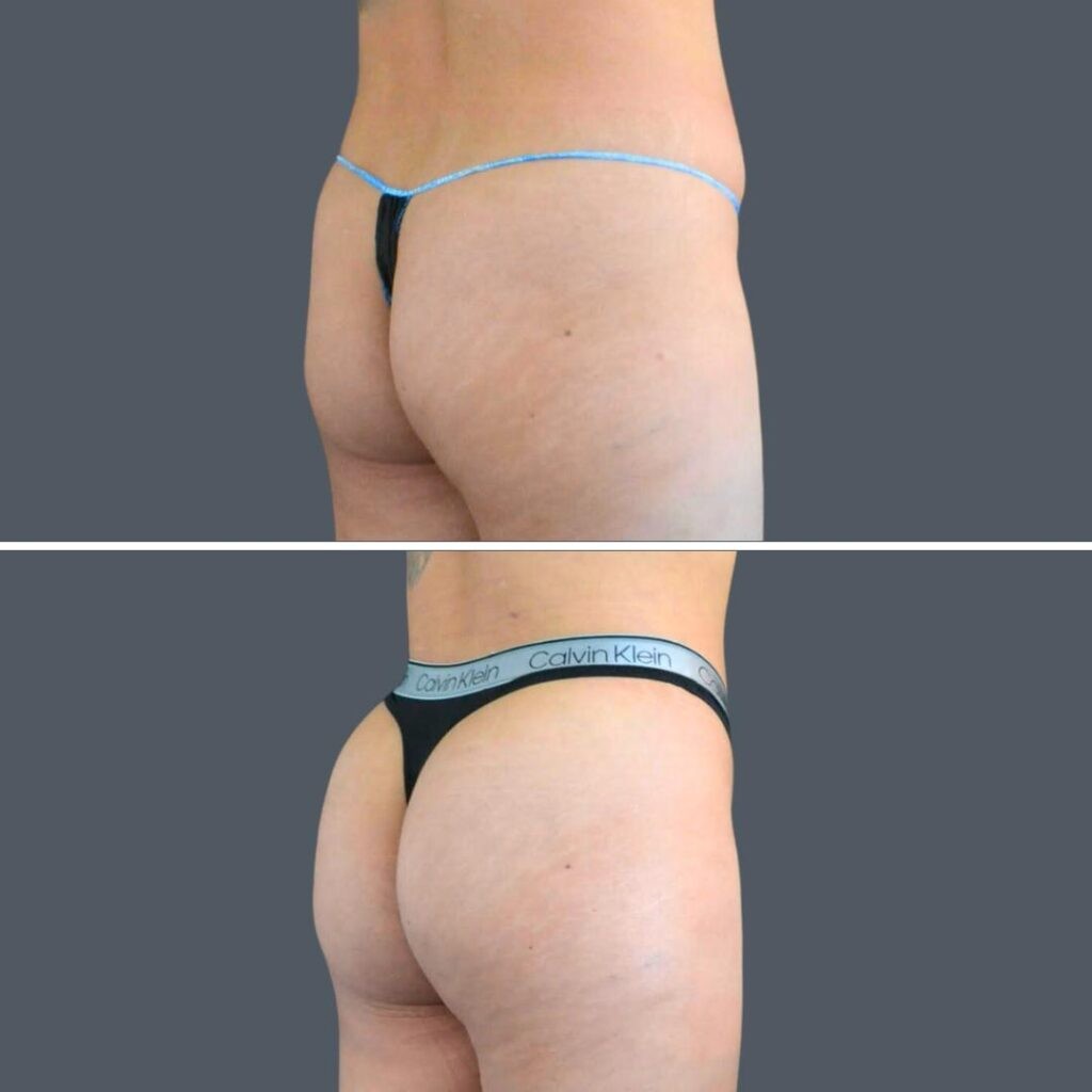 Canberra Bbl Liposuction Female 2024 Kp 001 Before And After