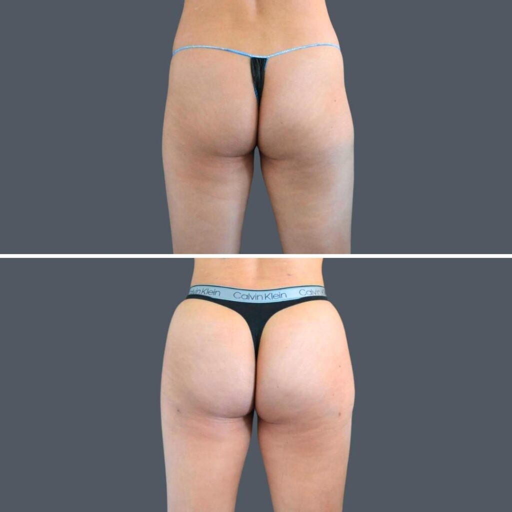 Canberra Bbl Liposuction Female 2024 Kp 002 Before And After