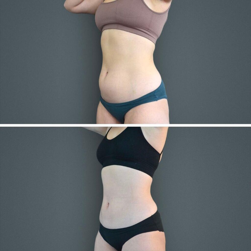 Canberra Coolsculpting Stomach Female 2022 Right Se Before And After
