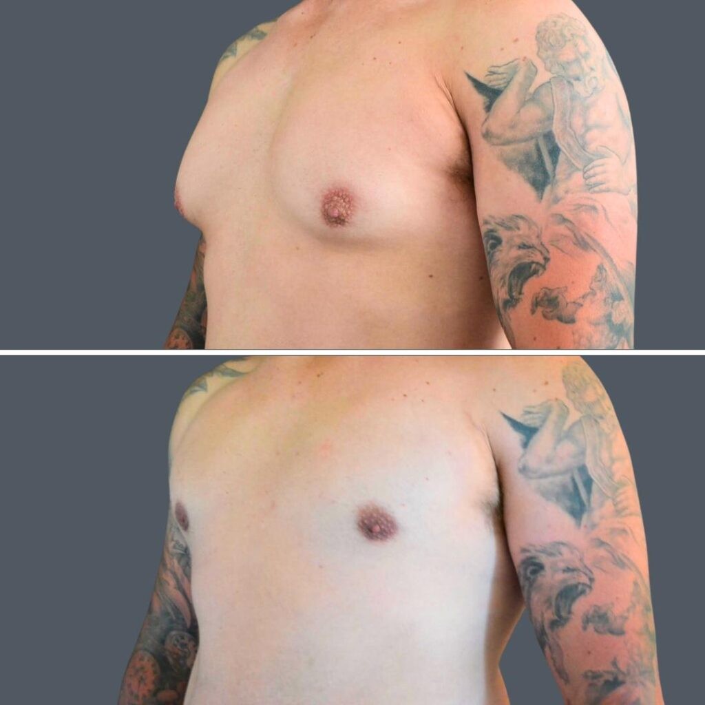 Canberra Gynecomastia Male 2024 Cm 001 Before And After