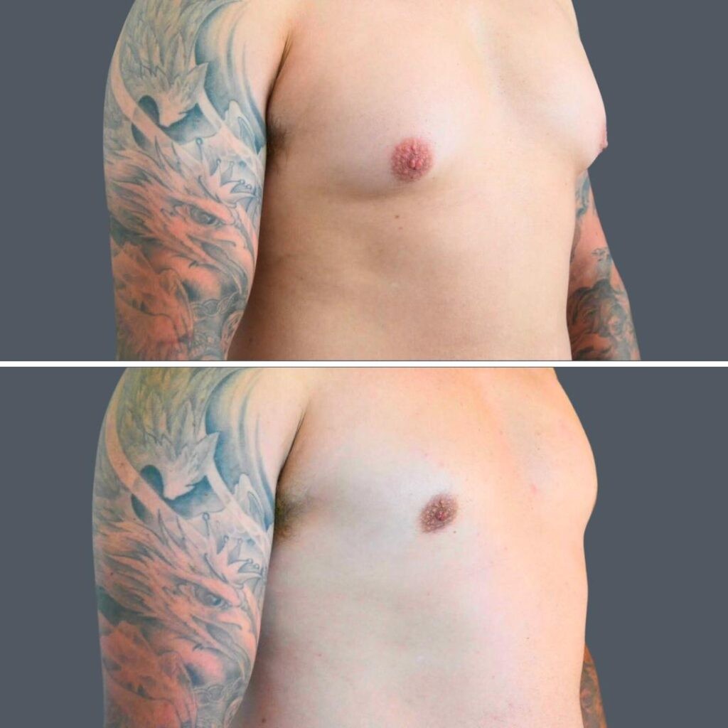 Canberra Gynecomastia Male 2024 Cm 002 Before And After
