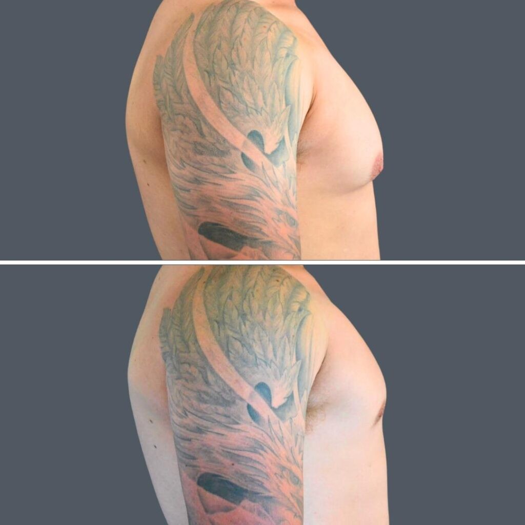 Canberra Gynecomastia Male 2024 Cm 003 Before And After