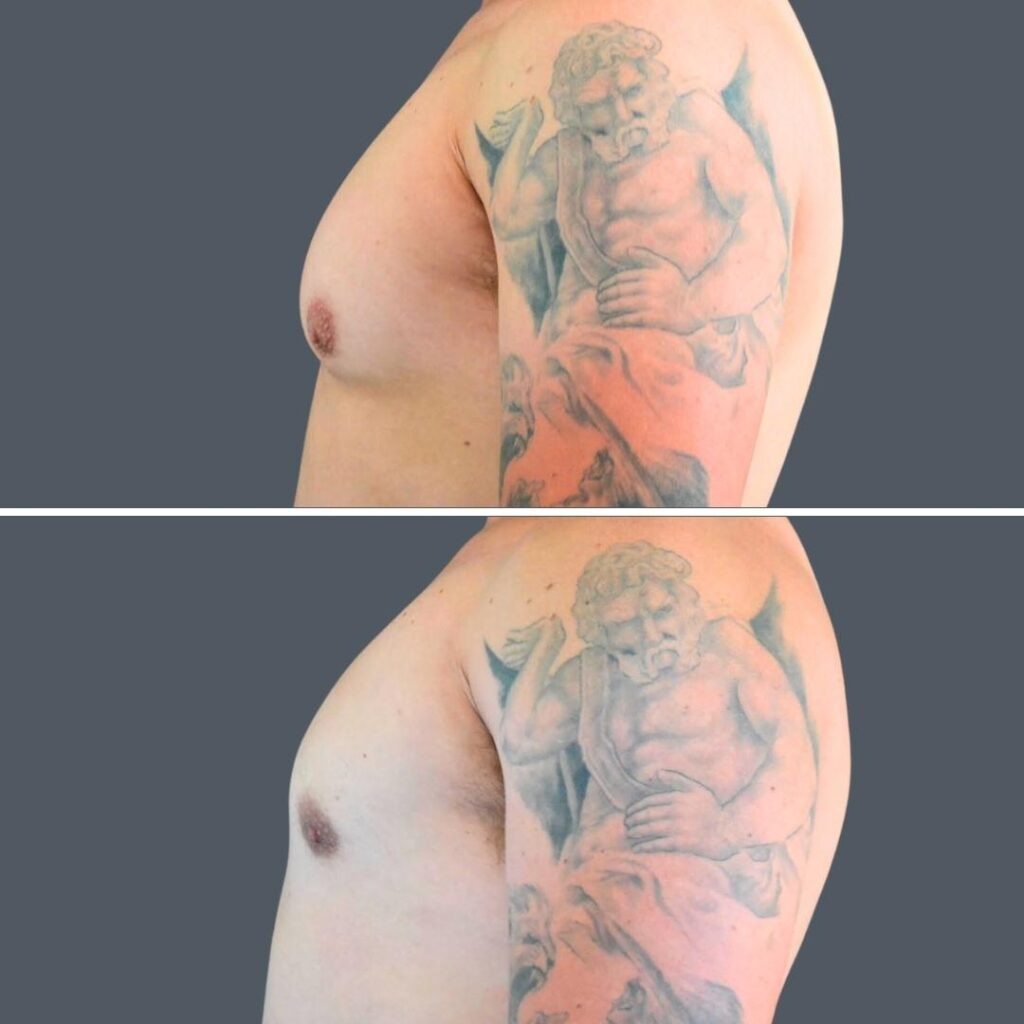 Canberra Gynecomastia Male 2024 Cm 004 Before And After