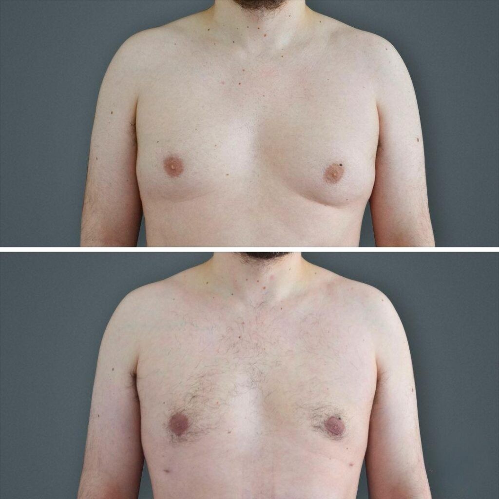 Canberra Gynecomastia Male Chest 2021 Front Ss Before And After