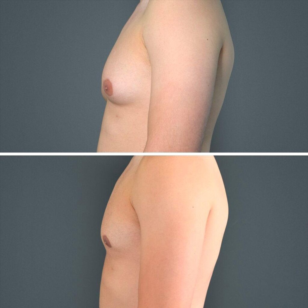 Canberra Gynecomastia Male Chest 2022 Right Ta Before And After