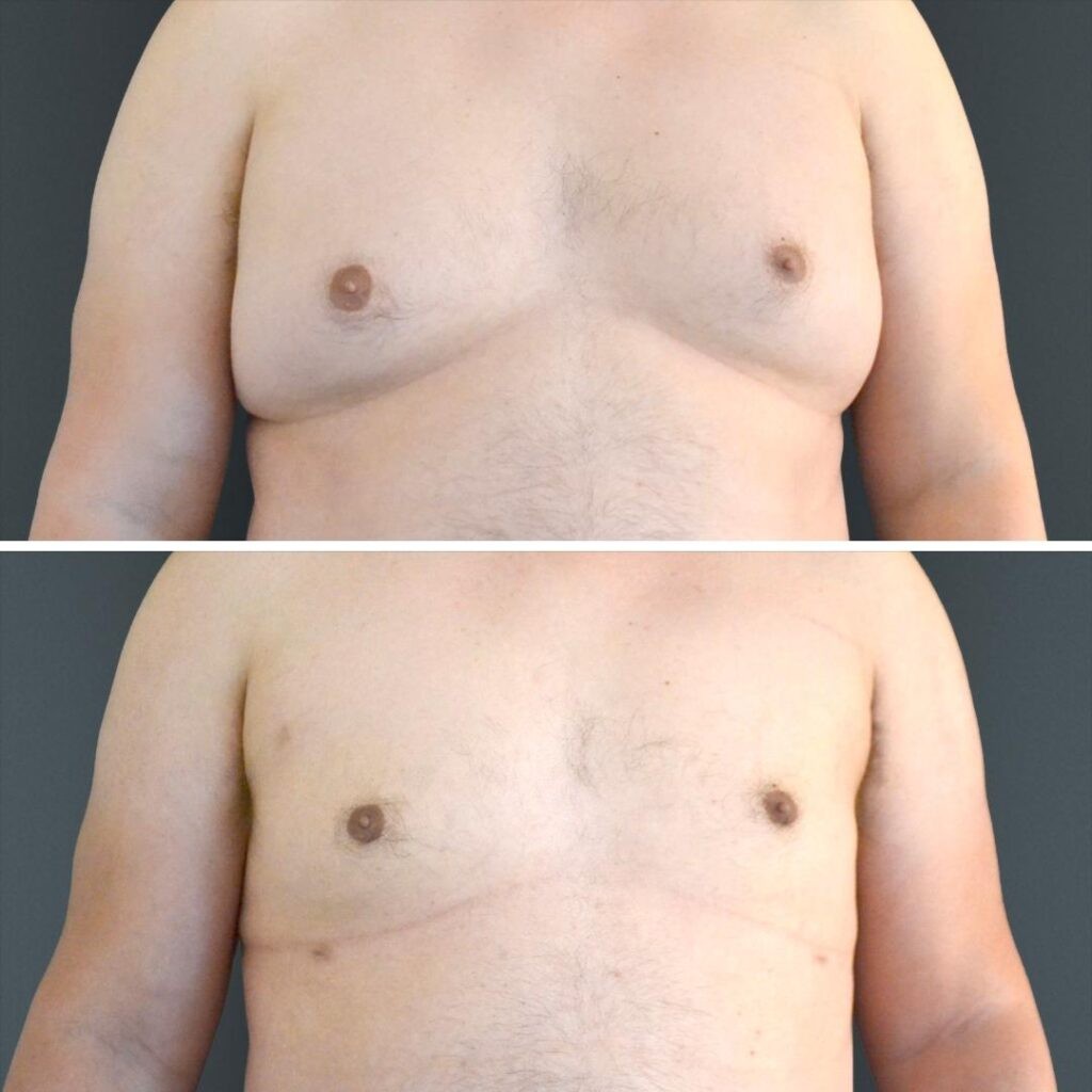 Canberra Gynecomastia Male Chest 2023 Front Tn Before And After